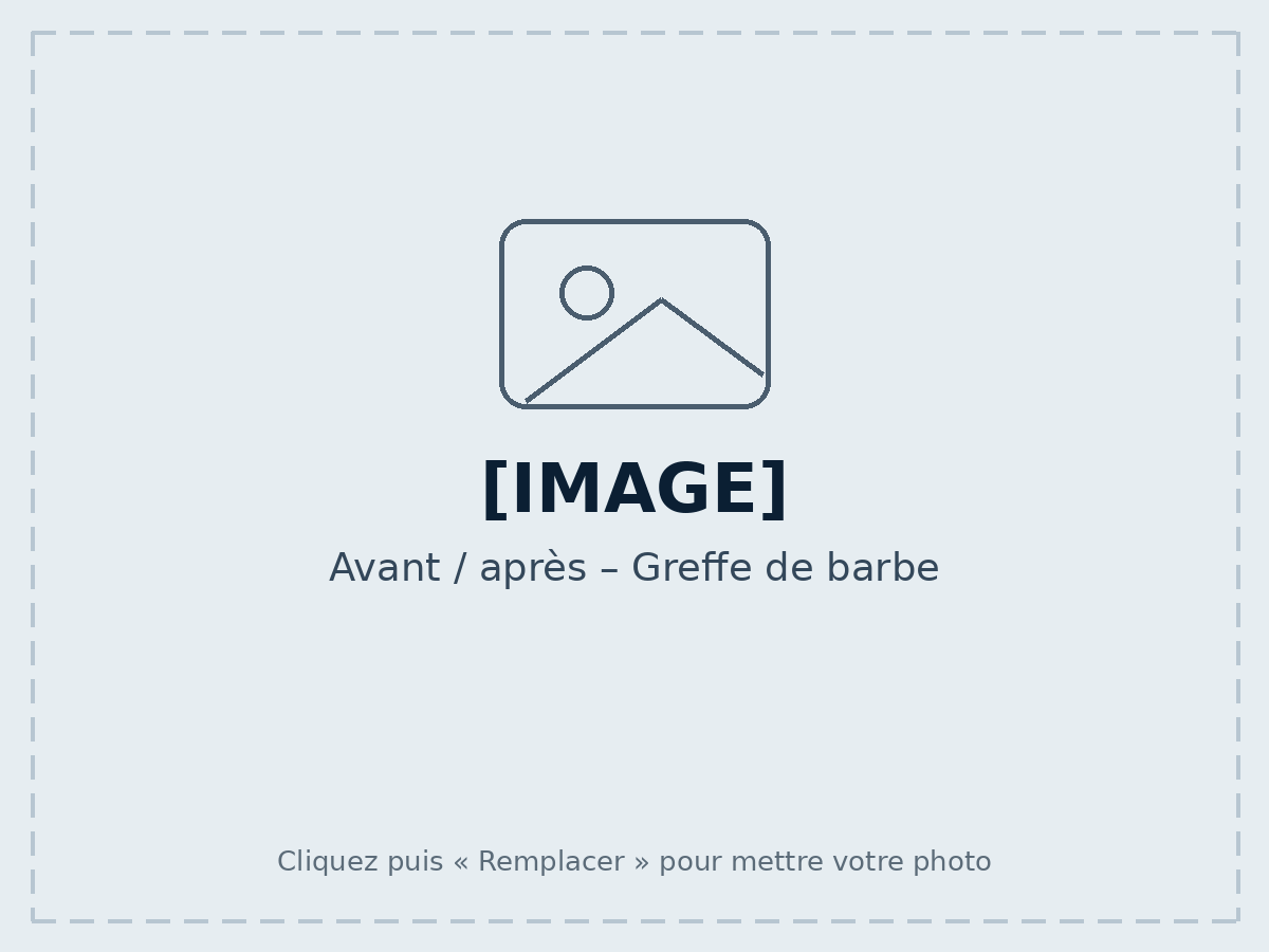 Avant / après – Greffe de barbe