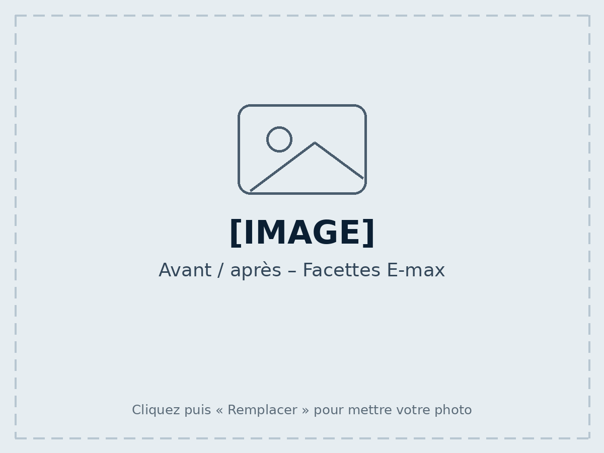 Avant / après – Facettes E-max