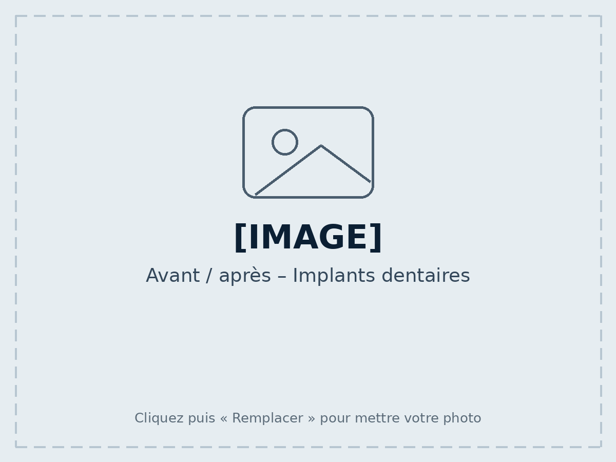 Avant / après – Implants dentaires