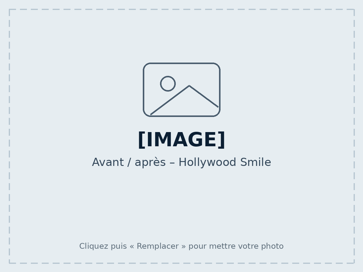 Avant / après – Hollywood Smile