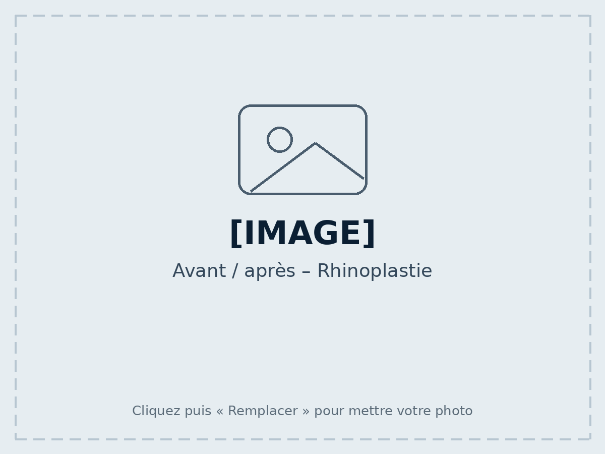 Avant / après – Rhinoplastie