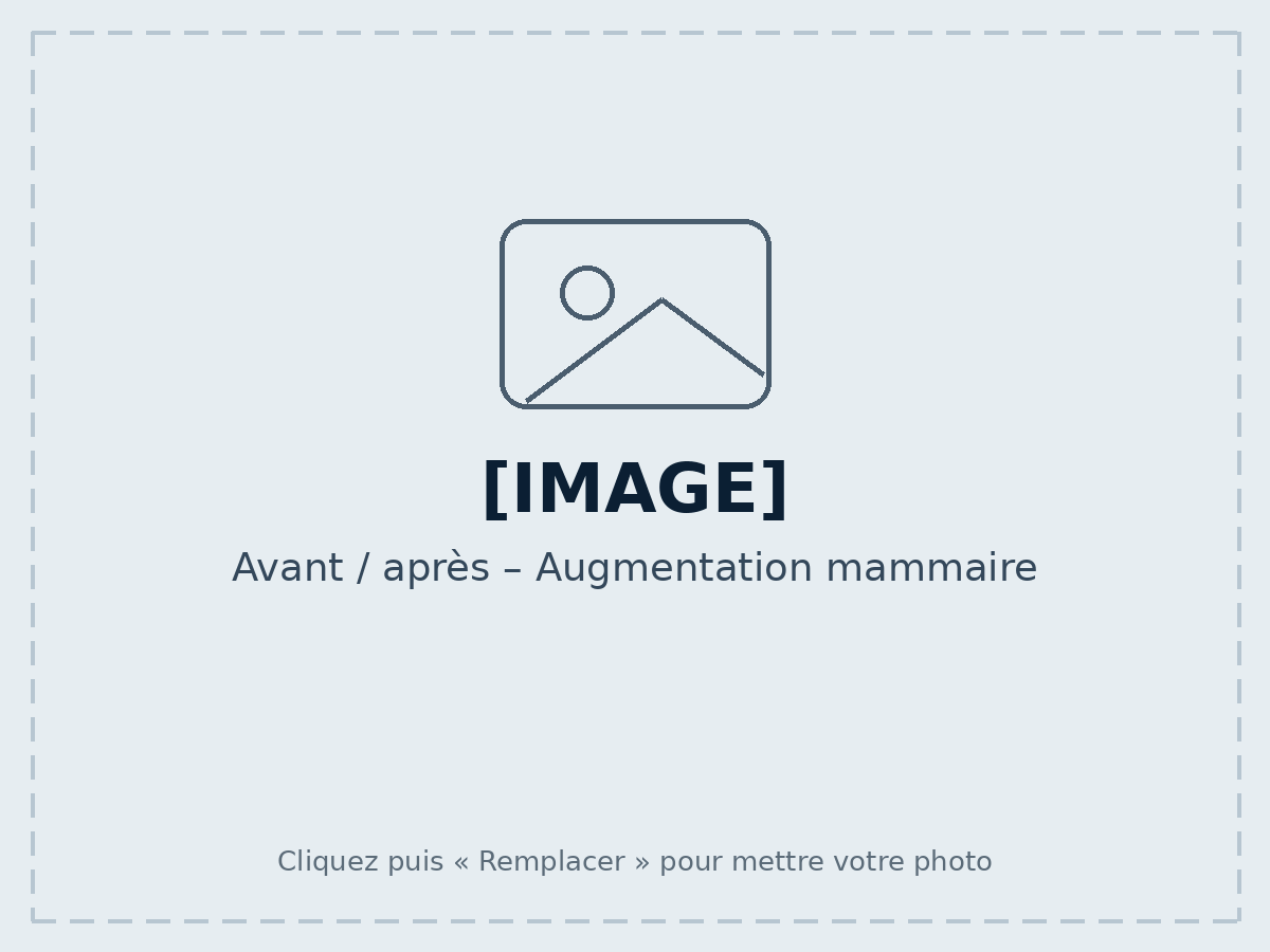 Avant / après – Augmentation mammaire
