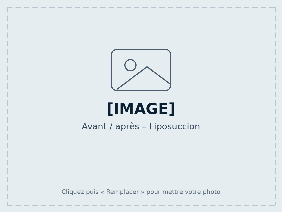 Avant / après – Liposuccion
