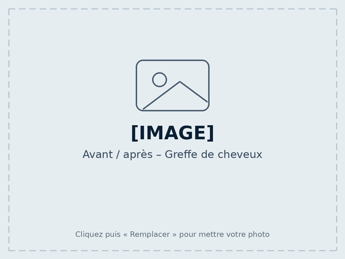 Avant / après – Greffe de cheveux